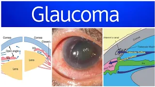 Glaucoma 3 | Primary Open Angle Glaucoma