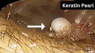 Keratin pearls in ear canal | bilateral symmetrical | without surgery