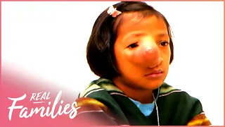 Girl With Face Deformity Crosses the World for Surgery|Little Miracles|Real Families