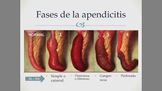 Apendicitis aguda