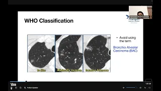 NBE-APPROACH TO SOLITARY PULMONARY NODULE & SCREENING IN LUNG CANCER- DR. SARVANA & DR. PRASANTH