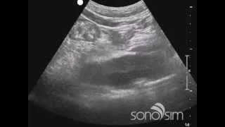 SonoSim Ultrasound Challenge - Aorta/IVC