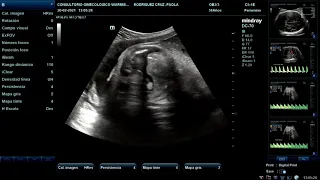 Ecografía Doppler Fetal