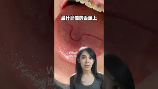 他舌頭上的印痕怎麼來的#牙齒矯正#牙套