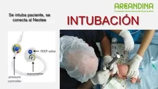 Intubación Neonatal