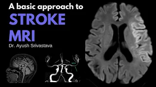 Stroke MRI: Approach to diagnosis and role of intervention