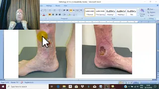 Venous Disorders in English 11 ( Varicose veins , complications ) , by Dr.Wahdan