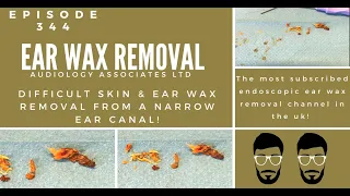 DIFFICULT SKIN & EAR WAX REMOVAL FROMA NARROW EAR CANAL - EP 345