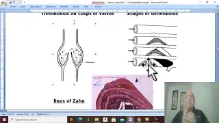 Venous Disorders in Arabic 4 ( DVT , part 2 ) , by Dr. Wahdan .