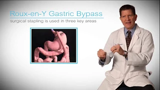 Bariatrics | Roux-en-Y Gastric Bypass for Weight Loss | Ascension Borgess | Michigan