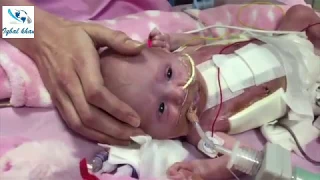 Baby born with her heart outside her body has survived after surgery