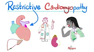 Restrictive Cardiomyopathy | Causes, Symptoms, Diagnosis & Treatment | Cardiology Series