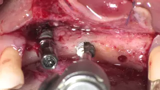 Ankylos 6.6mm clinical video by Marco Degidi