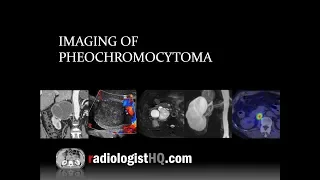 Imaging of Pheochromocytoma