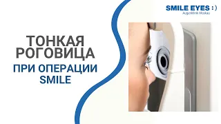 Тонкая роговица при операции SMILE - можно ли делать лазерную коррекцию зрения?