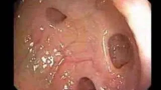 Diverticulosis