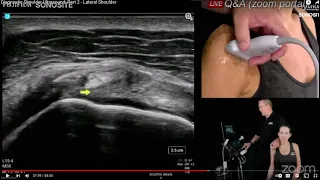 Diagnostic Shoulder Ultrasound: Part 2 - Lateral Shoulder