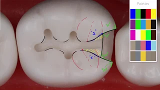 Class II Amalgam #19 MO Acadental | Amalgam Preparation Technique