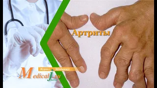 Артриты: причины развития заболевания, симптомы, лечение, прогноз