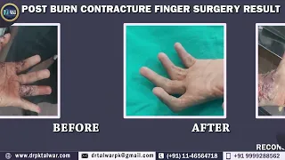 Reconstruction of Post-Burn Contracture of Fingers | Post-Burn Surgery- Before & After Results