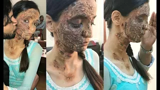 Sanaya Irani SHOCKING Performance With BURNT Face In Nach Baliye 8