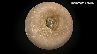 kid's mammoth earwax (removal failed)