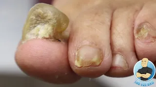 CUTTING PAINFUL SUPER THICK TOENAILS THAT SHE HID FROM HER FAMILY!!!