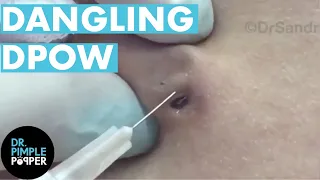 This DPOW Didn't Want to Leave the Nest! Dr Pimple Popper vs Dilated Pore of Winer