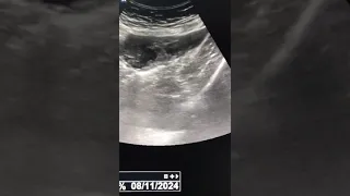 Ectopic Pregnancy Ultrasound Scan