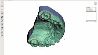 MeshMixer Ortho: Upper TPA via Augmented Model