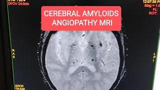 Cerebral Amyloid Angiopathy MRI