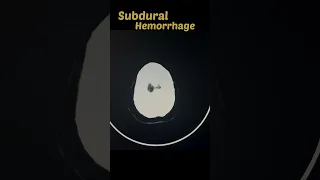 Subdural Hemorrhage  | Brain 🧠 bleed 🩸 | CT scan #ctscan #shorts