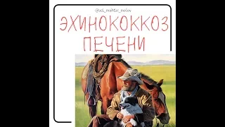 Эхинококкоз  печени на УЗИ органов брюшной полости