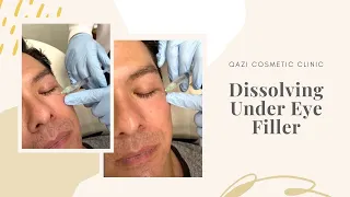 Dissolving Under Eye Fillers  | Live with Dr. Nadir Qazi