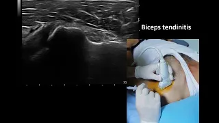 Ultrasound guided biceps tendinitis and rotator cuff tendinitis  injection, by Prof Murat Karkucak