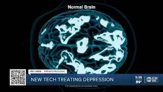 Depression sufferers who can't take medication can use new technology that improves symptoms