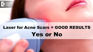 CAN I EXPECT GOOD RESULTS FROM LASER TREATMENT FOR ACNE SCARS? | DR RASYA DIXIT | ACNE CARE TIPS