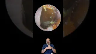 1CM SATISFYING EAR WAX PLUG REMOVAL  - EP 835 #earcare  #earclinic #earwaxremoval