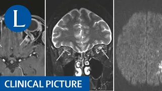 Neurological problems post vaccine against SARS-CoV-2