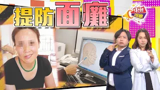 【on.cc東網】東呼即應：面癱原因要搞清　對症下藥不宜遲