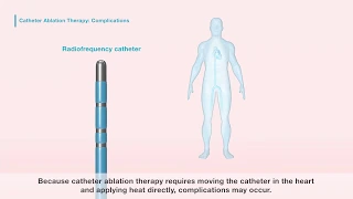 Catheter ablation for atrial fibrillation