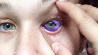 Model's Bungled Eyeball Tattoo Could Leave Her Blind
