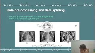 Automated Methods for detection & classification pneumonia based on X-Ray Images Using Deep
