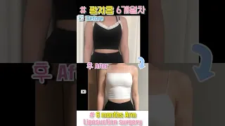 #365mc SHORTS | Liposuction Surgery | 6 Months Journey | Before and After