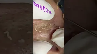 big blackheads 😯 on nose #foryou #acne #blackheads #pimple