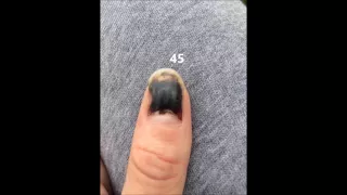 Chloe's Thumb - The Entire 66 Day Healing Process - Slammed in a Car Door