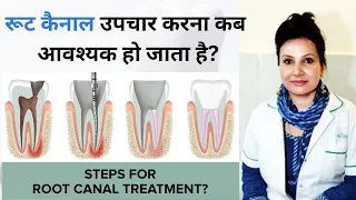 Root canal treatment in Hindi | कब कराना चाहिए रूट कैनाल ट्रीटमेंट ? What Is Root Canal Treatment
