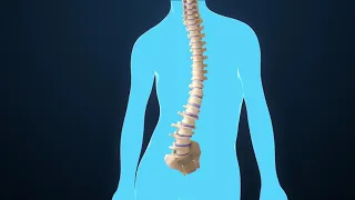 scoliosis