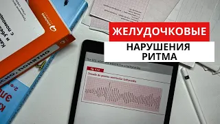 ЭКГ диагностика нарушений ритма сердца. Желудочковая Тахикардия. Фибрилляция желудочков.