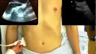 Small Bowel Obstruction Ultrasound from One Minute Ultrasound